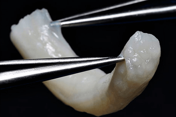 Avancement of Injury to Nerve