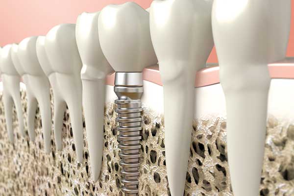 Bone Grafting & Implants in West Islip, NYC & Lake Success