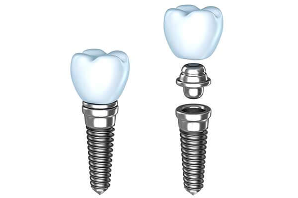 Single Dental Implants in West Islip, NYC & Lake Success