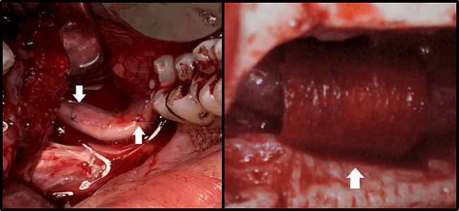 Figure 2 External Neurolysis