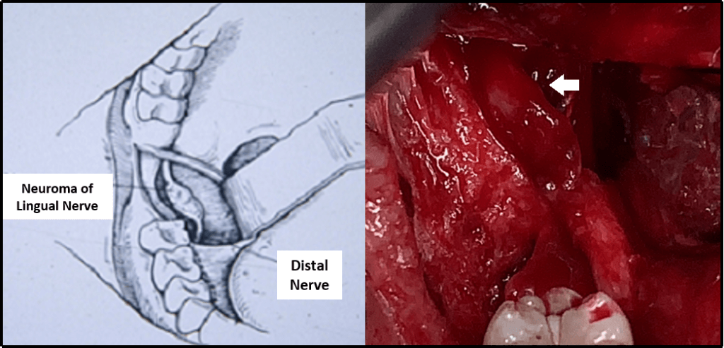 Figure 3 Photo of Neuroma of Lingual Nerve