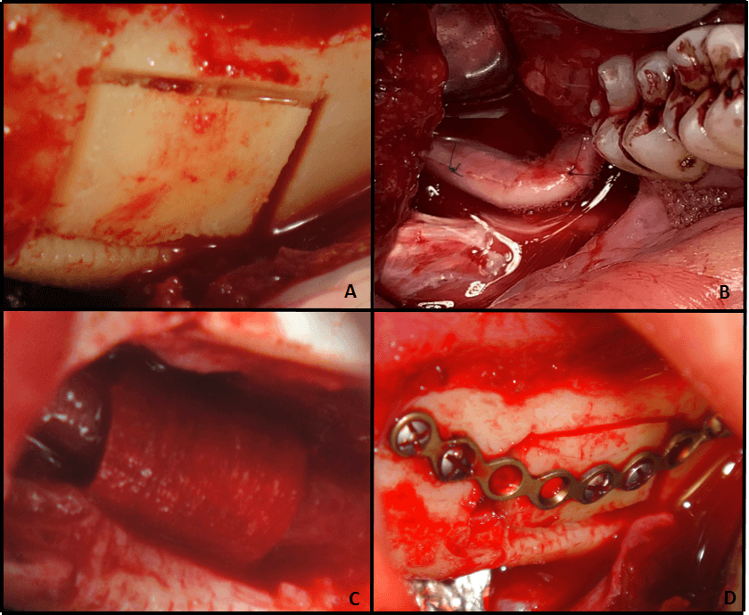 Figures 5 A-D Intraoperative Findings