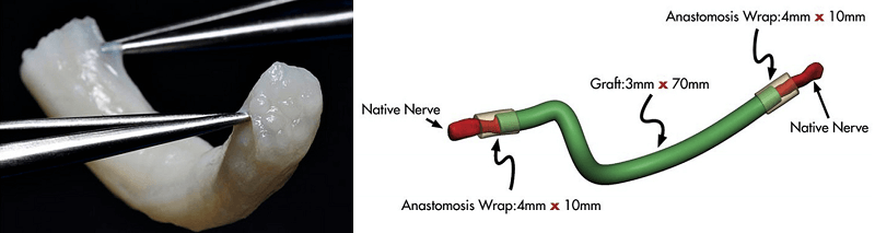 Figure 6 Image of Nerve Grafting