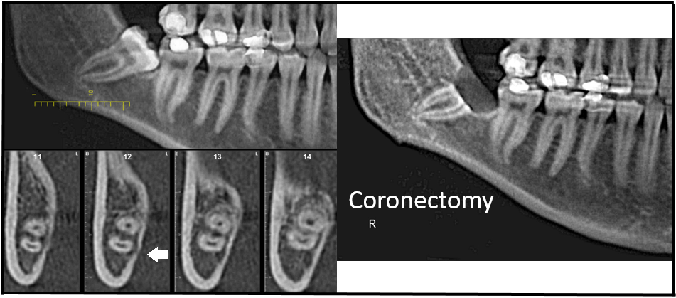 Figure 1 Coronectomy