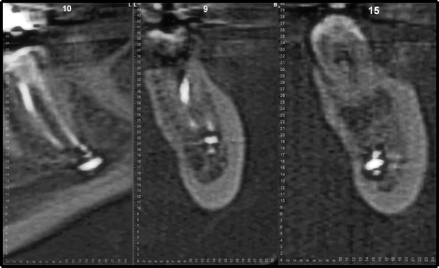 Figure 4 CBCT Demonstrating Root Canal Filling Material Within the IAN 