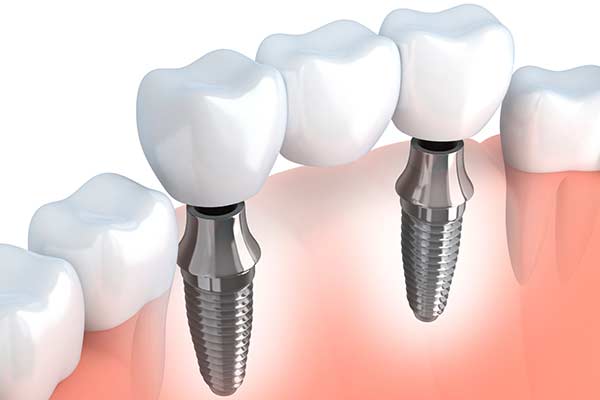 Implant Supported Bridge in West Islip, NYC & Lake Success